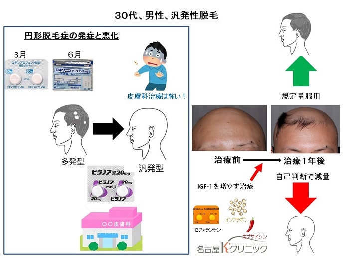 円形脱毛症　病院
